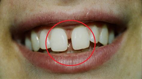 How to fix a teeth gap without braces, dental crown and bridge. how to get rid of gaps in your teeth without braces at ...