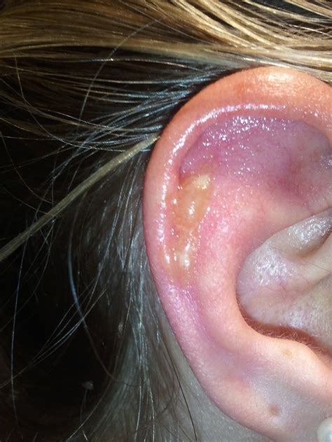 Fairly large blister developed on my outer ear cartilage.