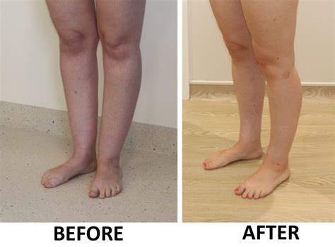 Ankle Cankle Surgery The Karri Clinic