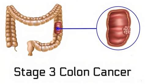 Colon Cancer Early Warning Signs And Stages Of Colon Cancer Page 14 Of 16 Healthella