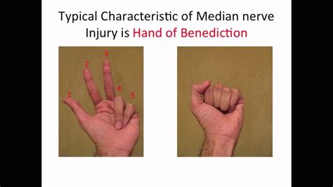 Typical Characteristic Of A Median Nerve Injury Youtube