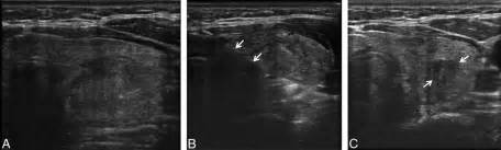 thyroid no surgery 101 radiofrequency rfa of a benign symptomatic thyroid nodule before and