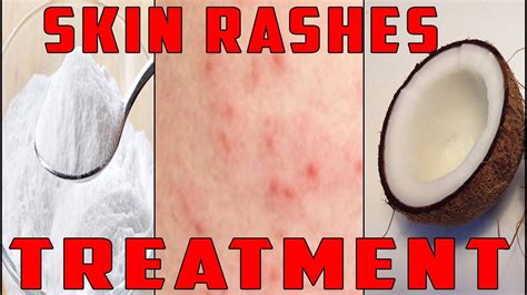 Skin Rash Treatment How To Treat Itchy Skin Rash Naturally Simple Home Remedy Youtube