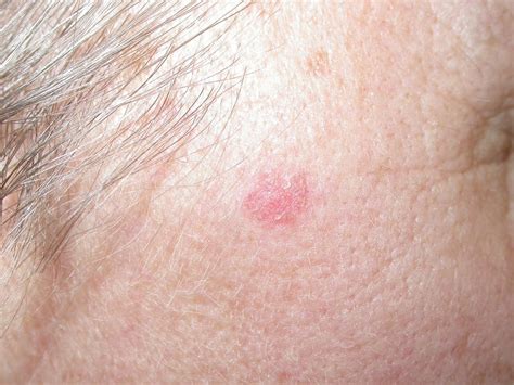 Skin Cancer Face Symptoms What Is Basal Cell Carcinoma Treatment Hot