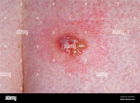 Close Up Of A Herpes Simplex Virus Hsv Type 2 Lesion On The Skin Of