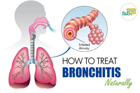 How To Treat Bronchitis Naturally Fab How