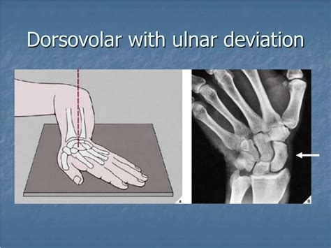 Ppt Fractures And Dislocations Of The Wrist Powerpoint Presentation