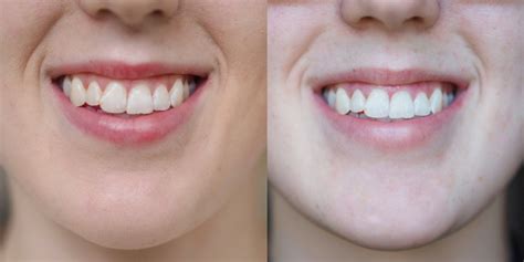 Transformation At Home Teeth Whitening Smile Brilliant The Vic Version