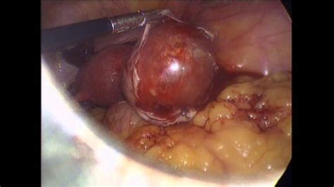 Laparoscopic Ovarian Cystectomy For Ovarian Dermoid Cyst Dr Amit