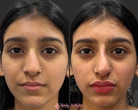 Russian Lip Filler Before And After Results Skinly Aesthetics