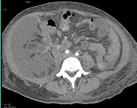 Perforated Appendix With Abscess Colon Case Studies Ctisus Ct Scanning
