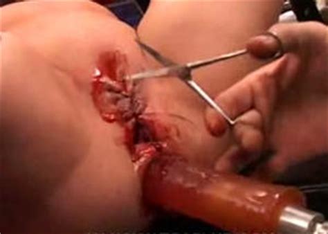 Needle Pain Bdsm Extreme Tit Torture Pussy Torture Page