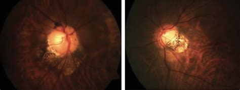 Study Explores Role Of Posterior Staphyloma In Myopic Maculopathy