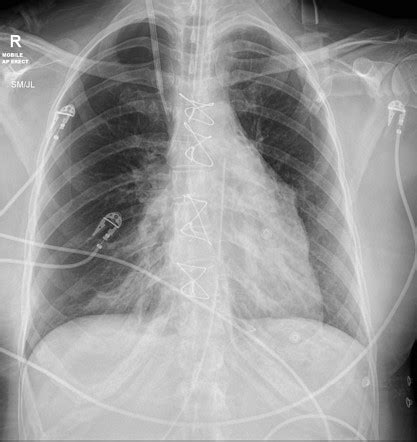 Iatrogenic Pneumothorax Radiology Case Radiopaedia Org