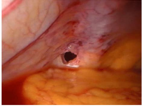 Laparoscopic View Of Diaphragmatic Rupture After Open Heart Surgery