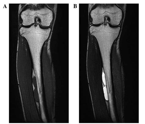 First Case Report Of An Intracortical Lipoma In An Adult Tibia