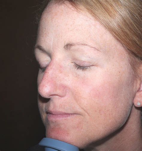 Before And After Pictures Of Actinic Keratosis In Cha Vrogue Co