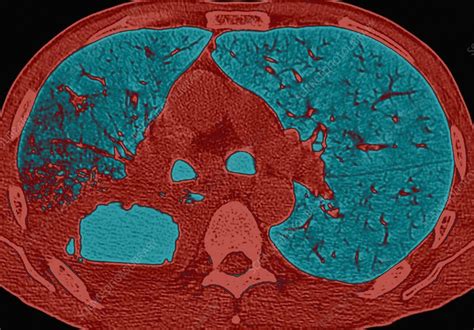 Lung Abscess Ct Scan Stock Image C0187141 Science Photo Library