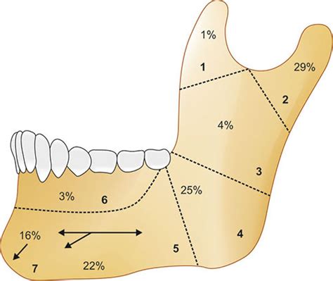 The Comprehensive Aocmf Classification System Mandible 49 Off