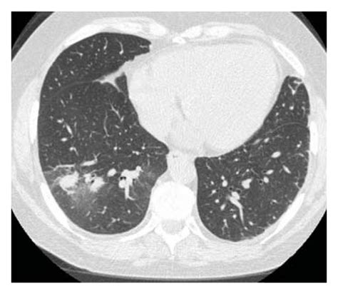 Chest Ct Scan Without Intravenous Contrast On Initial