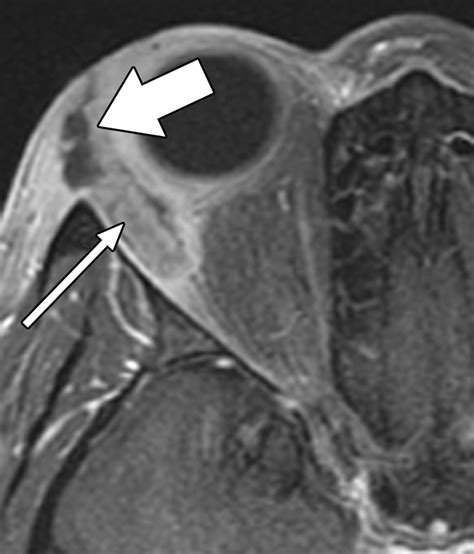 Mri Of Orbital Cellulitis And Orbital Abscess The Role Of Diffusion
