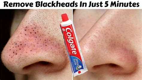 View How To Get Rid Of Pores And Blackheads  How To Clean Face At Home