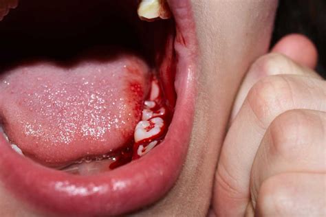 Mouth Cancer Symptoms 10 Early Warning Signs Of Mouth Cancer