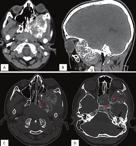 Head Ct Scan Axial A Sagittal B Images At The Intermediate