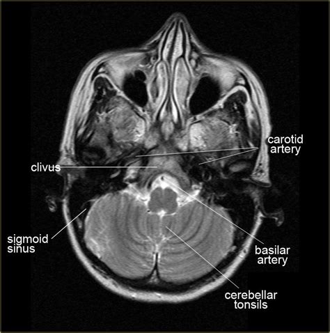 On The Left A Coronal View Of The Segments Of The Middle Cerebral