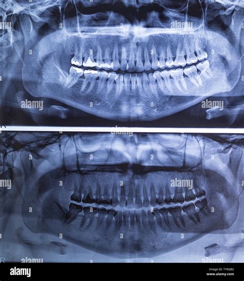 Dental X Ray Panoramic Of Upper And Lower Jaw Stock Photo Alamy