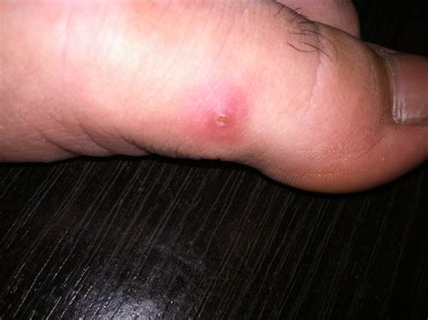 Itchy Bump On Toe Pictures Photos
