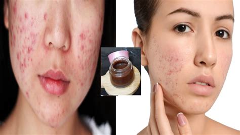 Acne Treatmenthow To Get Rid Of Acne Scars Dark Spots Pimple Marks