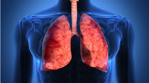 Fibrosis Pulmonar Causas S Ntomas Y Tratamiento