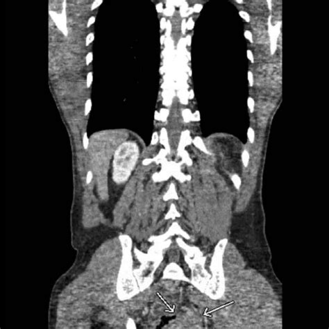 Ct Abdomen And Pelvis With Iv Contrast Showing 41 × 56 Cm Enhancing