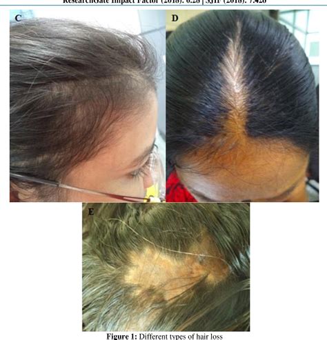 Pdf A Clinical Study Of Diffuse Hair Loss In Women In Tertiary Care