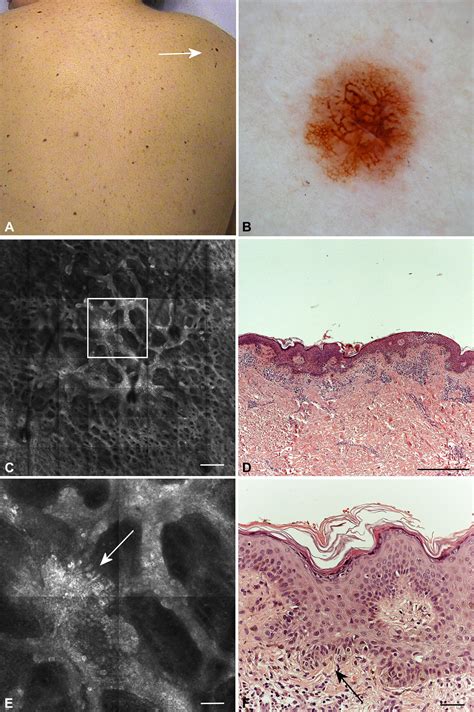 In Vivo Confocal Microscopy For Detection And Grading Of Dysplastic