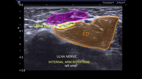 Ulnar Nerve Ultrasound