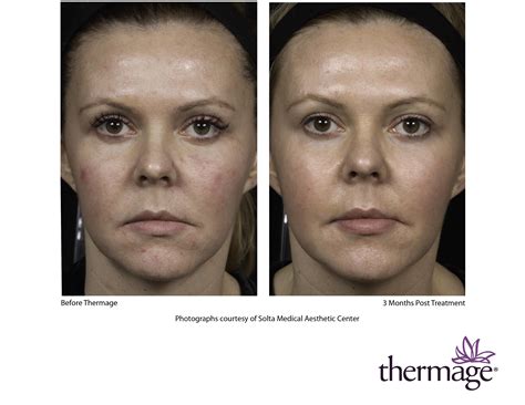 Thermage Nyc Info About Thermage Procedures And Cost Dr Michele Green