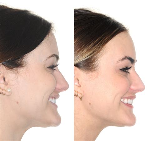 Before And After How Invisalign Created Fuller Lips And A Stronger Jawline — Lemchen Salzer