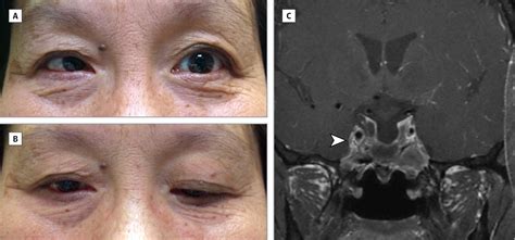 Ptosis Miosis And Intermittent Esotropia Following Pituitary Adenoma