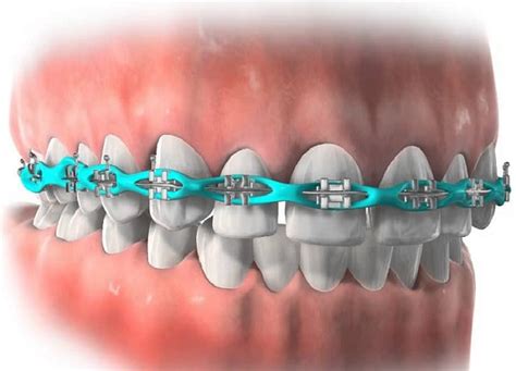 Do power chains help an overbite. Orthodontic Power Chain Braces Before & After, Types, Use ...