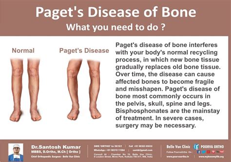 Stages Of Paget S Disease Skin