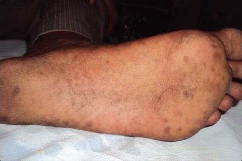 Clinical Photograph Showing Hyperpigmented Macules On Soles