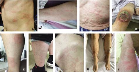 Cutaneous Manifestations Of Autoinflammatory Diseases