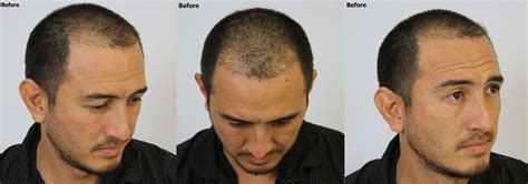 Hair Restoration Repair With Fue Alvi Armani Hair Transplant Los