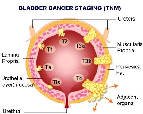 A malignant tumor on the. Symptoms Of Bladder Cancer - How To Recognize Bladder ...