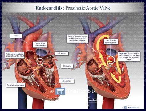 Endocarditis Prosthetic Aortic Valve Trialexhibits Inc