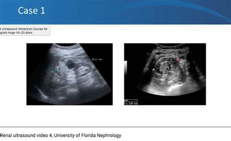 Point Of Care Ultrasound Pocus Videos Renal Fellow Network