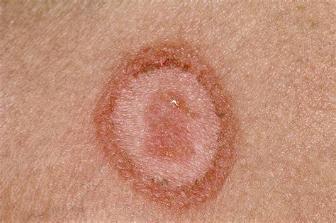 Ringworm Stock Image C0514699 Science Photo Library