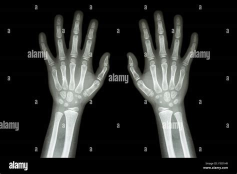 Film X Ray Normal Both Hands Of Child Stock Photo Alamy